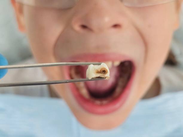 Best Emergency Wisdom Teeth Removal in Algonac, MI